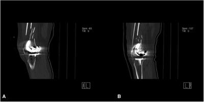 Staged open reduction and internal fixation with double-locking plates to treat bilateral distal femur periprosthetic fractures after total knee arthroplasty: A case report